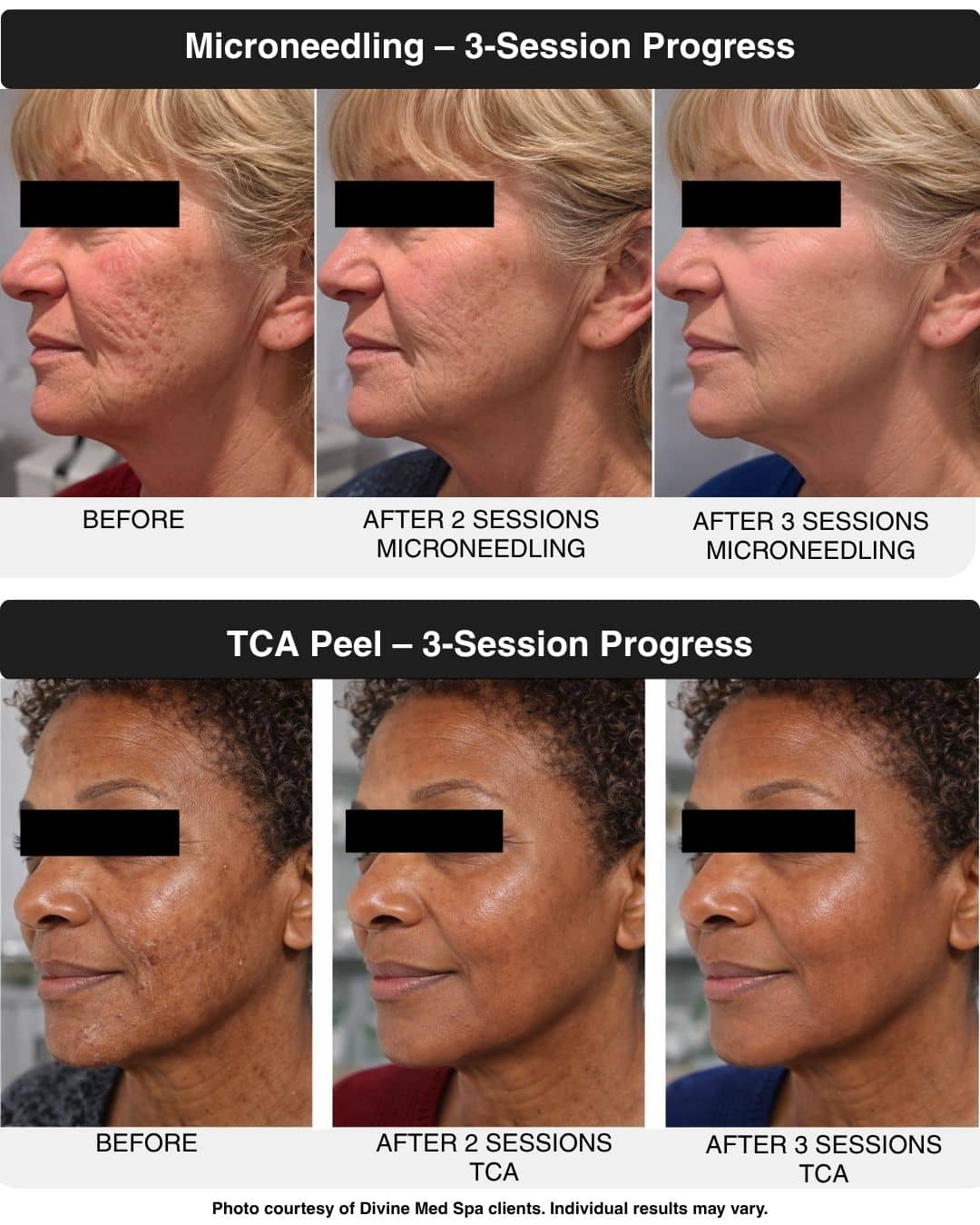 Microneedling and TCA (1) Microneedling and TCA chemical peel treatment progress at Divine Med Spa